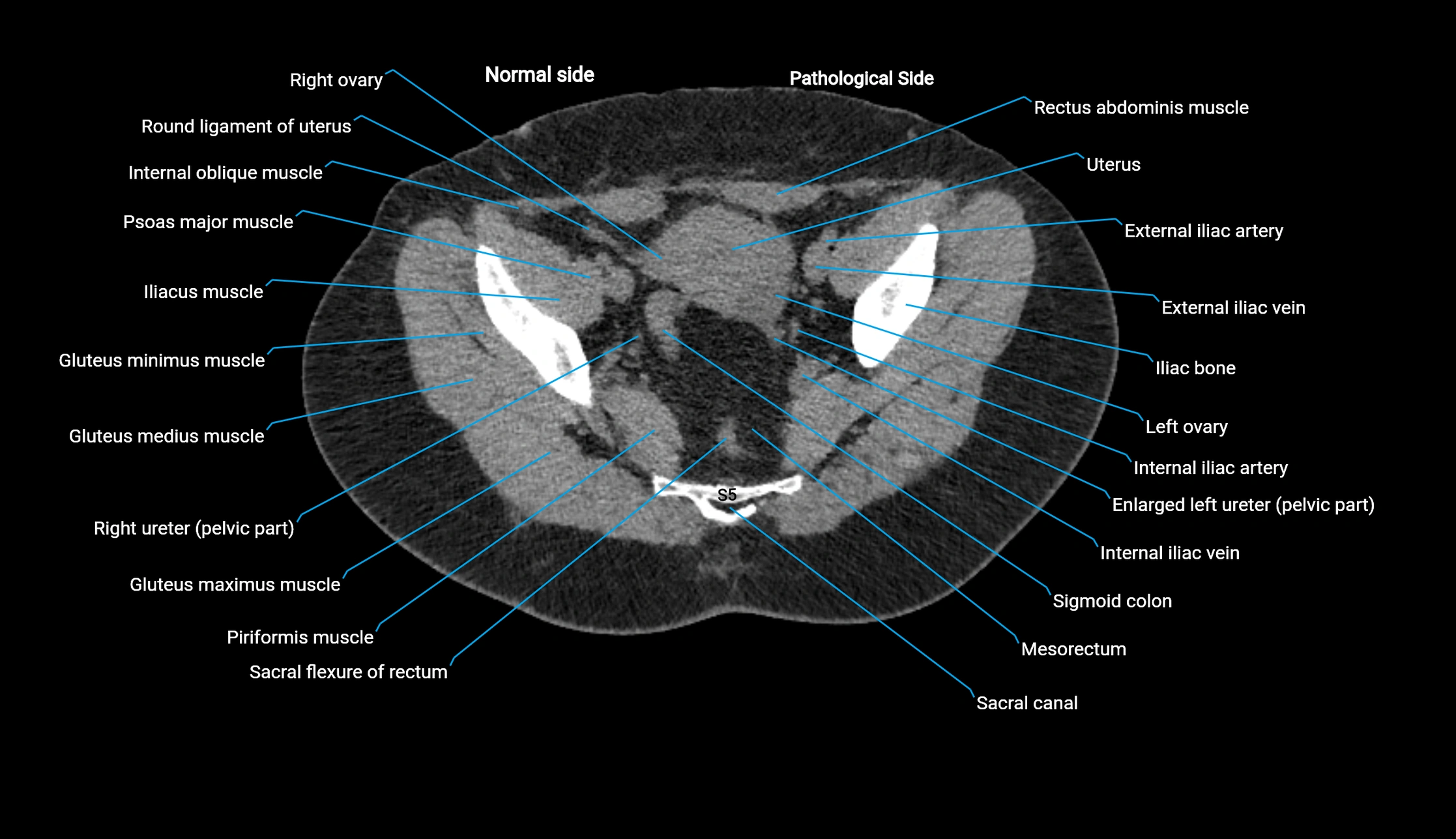 CT KUB axial cross sectional anatomy  radiology image -img-00201-00138.webp
